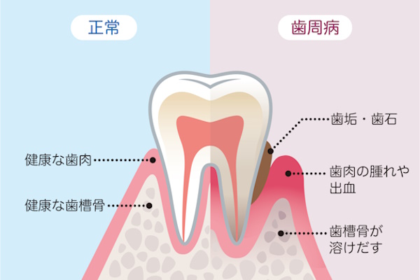 健康な歯と歯周病の歯　比較